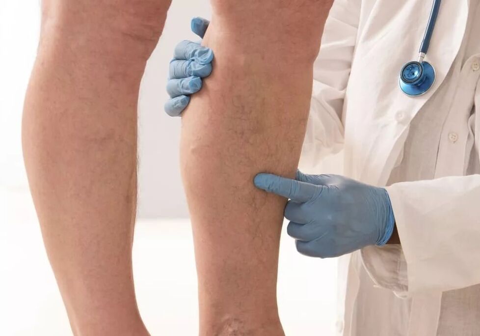 The doctor examines the legs with varicose veins