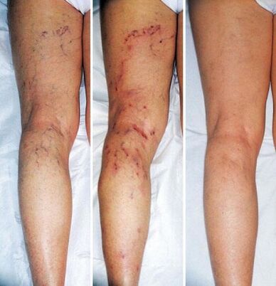 Lower limbs before and after treatment of varicose veins