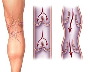 Normal functioning of valves in a healthy vein and pathology of valves in varicose veins