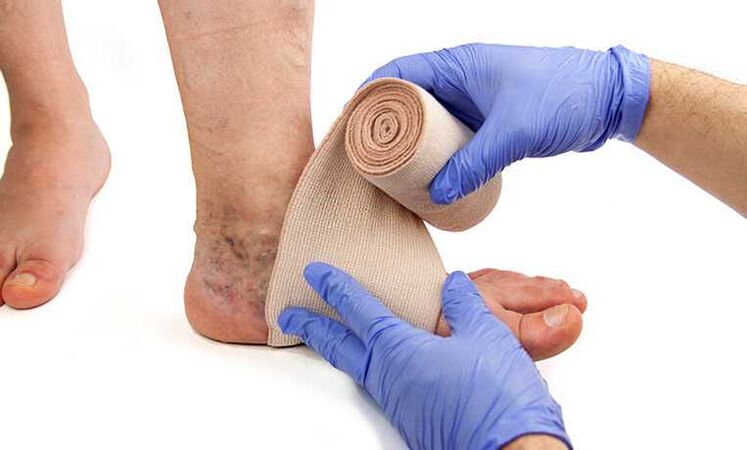 The treatment of varicose veins in the legs is completed with the use of compression stockings