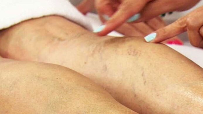 Varicosis of the lower extremities