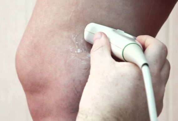 Diagnosis of varicose veins