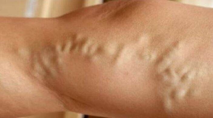 Varicose veins