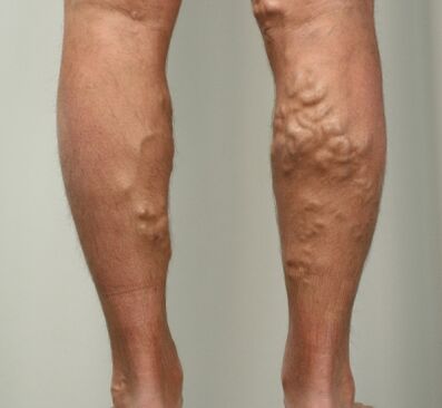 varicose veins