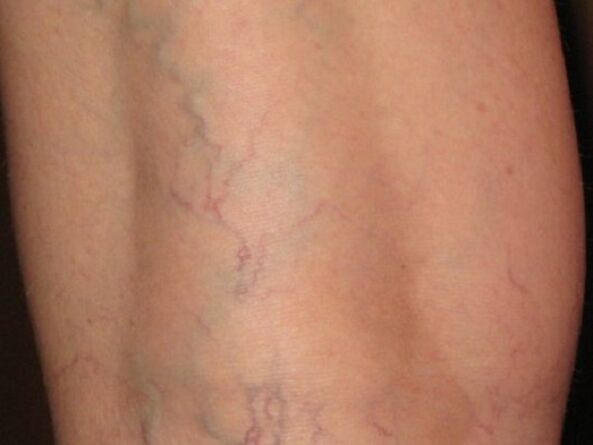 Stages of varicose veins