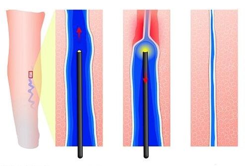 Laser clotting
