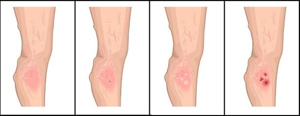 The degree of varicose veins