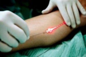 Laser treatment of varicose veins in the legs