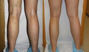 PHOTO before and after laser treatment of varicose veins