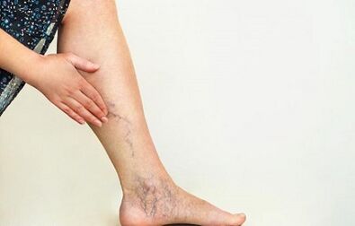 How to treat varicose veins of the sub-extremities