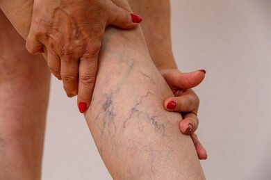 Varicosis of the lower extremities