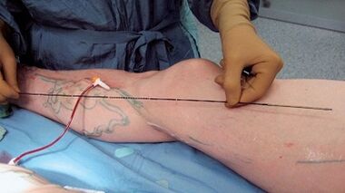 How is surgery for varicose veins performed