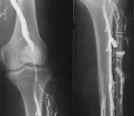 Diagnostic options for varicose veins of the extremities