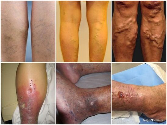 Rate of damage to varicose veins