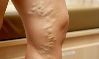 Signs and symptoms of varicose veins in the legs
